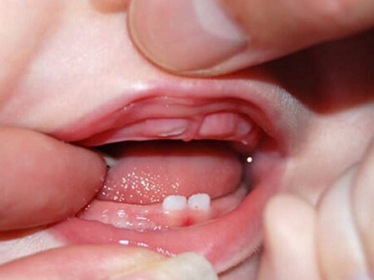 Biểu hiện nhận biết áp xe răng ở trẻ em
