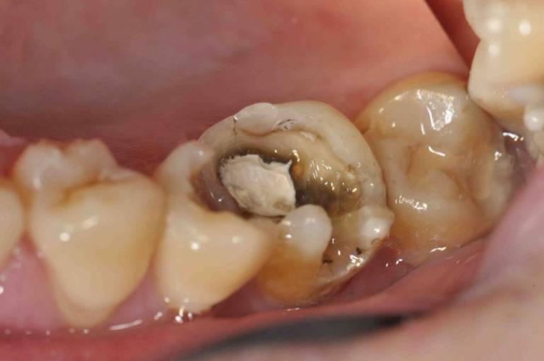 Bị viêm tủy răng có mủ phải làm sao?