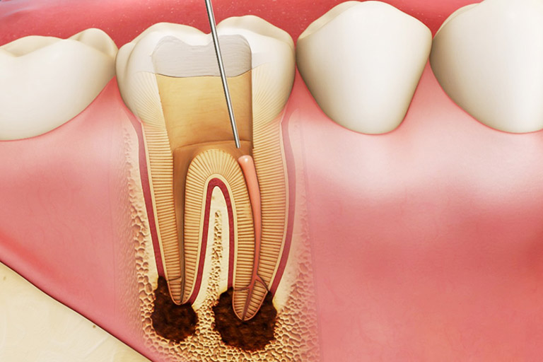 những biến chứng của bệnh sâu răng