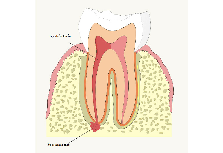 những biến chứng của bệnh sâu răng