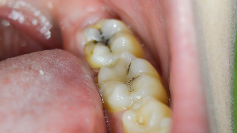 biến chứng của bệnh sâu răng