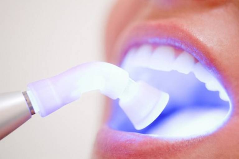 Răng bị ê buốt sau khi tẩy trắng là do đâu?