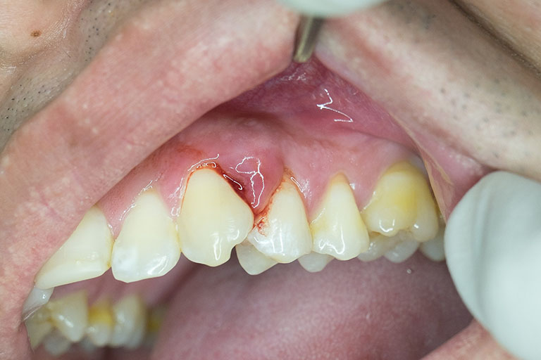 chảy máu chân răng là bệnh gì