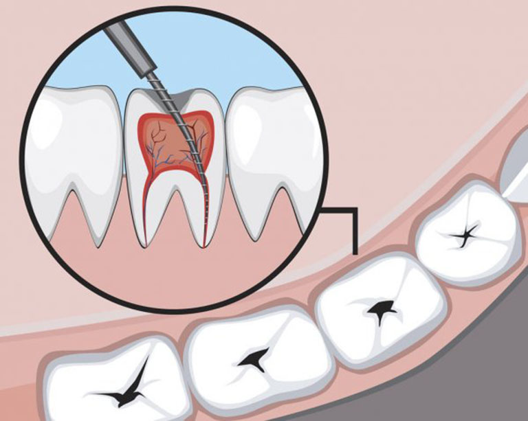 quy trình chữa tủy răng