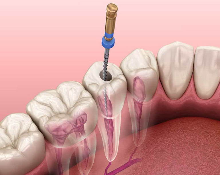 Điều trị nội nha giúp chữa tủy răng xong vẫn đau nhức