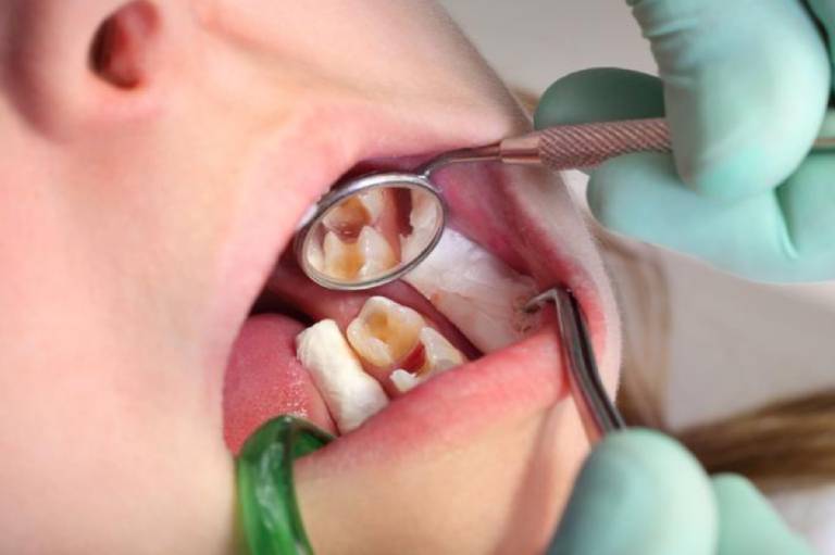 Khi nào nên lấy tủy răng là phù hợp nhất?