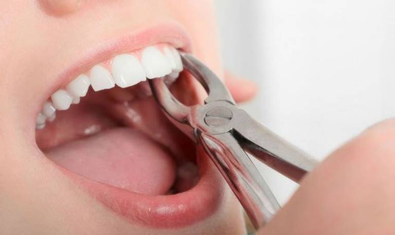 Các biện pháp xử lý khi ổ mủ áp xe chân răng tự vỡ