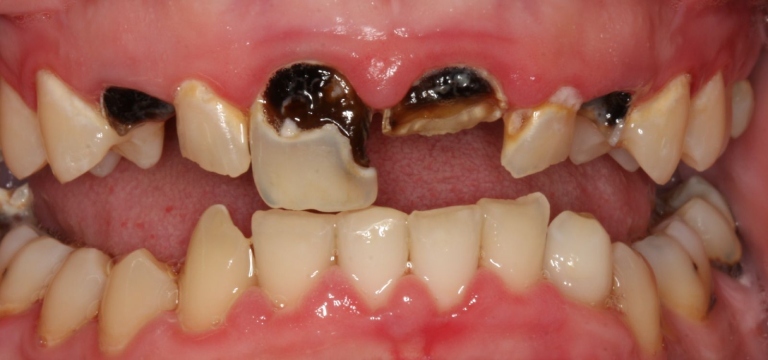 Răng bị chết tủy có nên nhổ