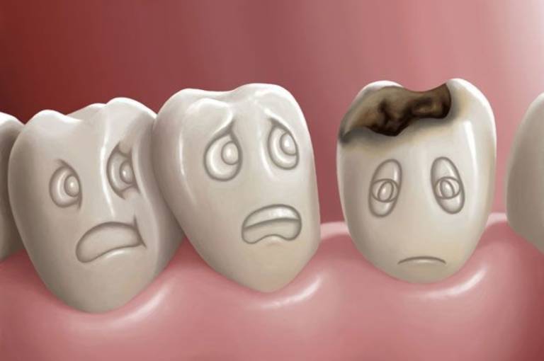Răng bị sâu có niềng răng được không?