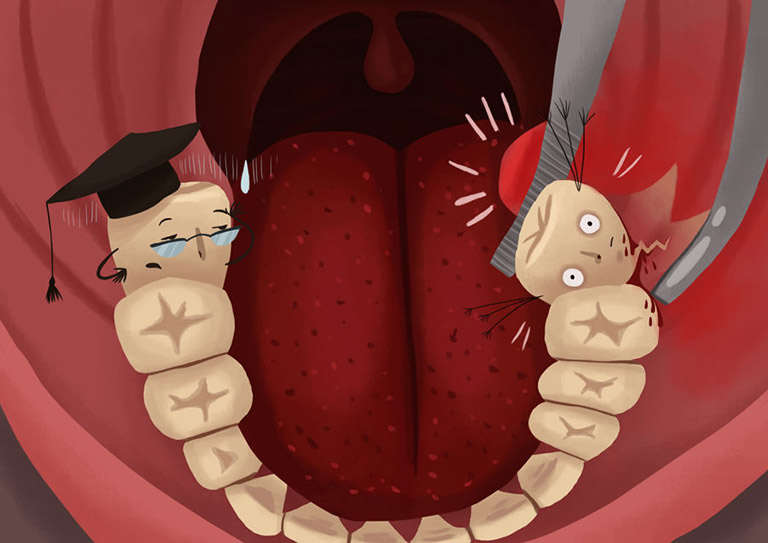 cách chữa sâu răng khôn
