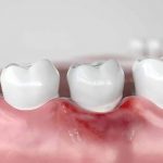 Răng sâu bị chảy máu liên tục có nguy hiểm không?