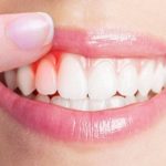 Răng sâu chảy máu: Nguyên nhân và cách chữa trị