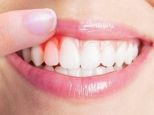 Răng sâu chảy máu: Nguyên nhân và cách chữa trị