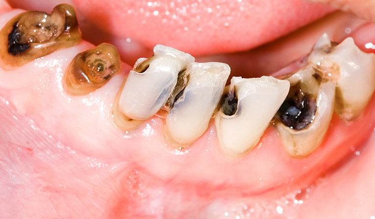 sâu răng có bị lây sang răng khác không