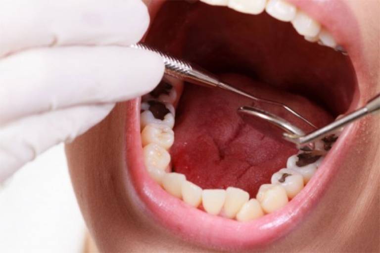 Thuốc diệt tủy răng có độc không?