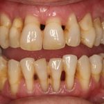 Tụt lợi hở chân răng: Nguyên nhân, dấu hiệu và điều trị