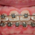 Dấu hiệu tụt lợi khi niềng răng và cách khắc phục