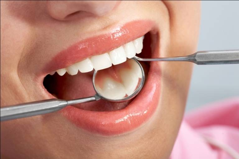 Phòng ngừa tụt lợi khi niềng răng hiệu quả