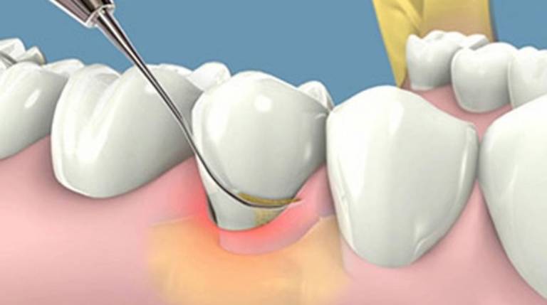 Lấy cao răng chữa viêm lợi hôi miệng