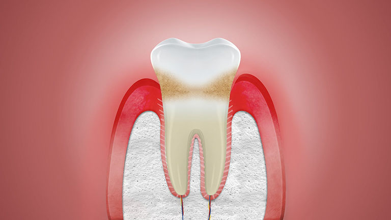 Viêm lợi làm răng lung lay 