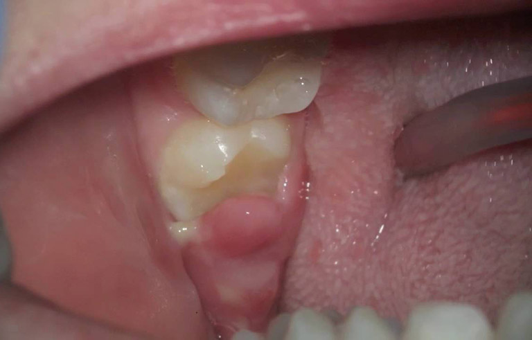 bị viêm lợi răng hàm