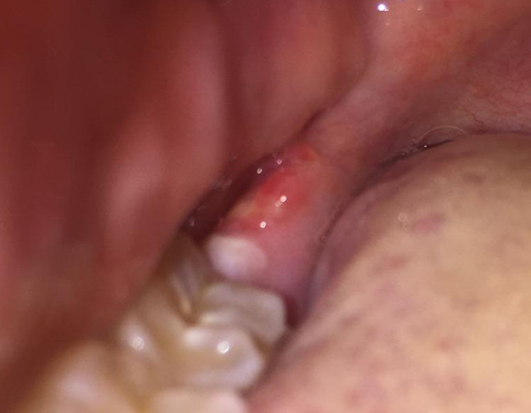 viêm lợi sau khi nhổ răng
