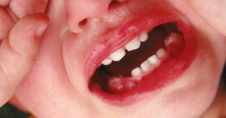 Nguyên nhân dẫn đến viêm nha chu ở trẻ em