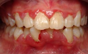 Viêm nướu triển dưỡng là gì? Nguyên nhân, triệu chứng và điều trị