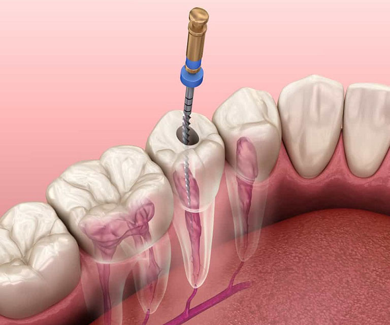 cách điều trị viêm tủy răng
