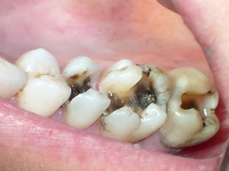 viêm tủy răng là gì