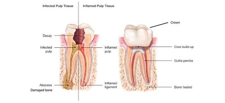 Triệu chứng viêm tủy răng