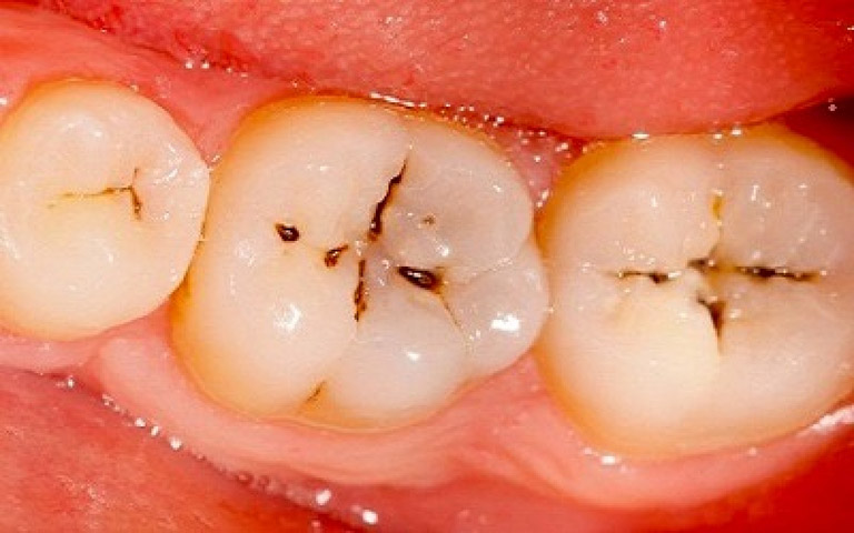 triệu chứng viêm tủy răng cấp