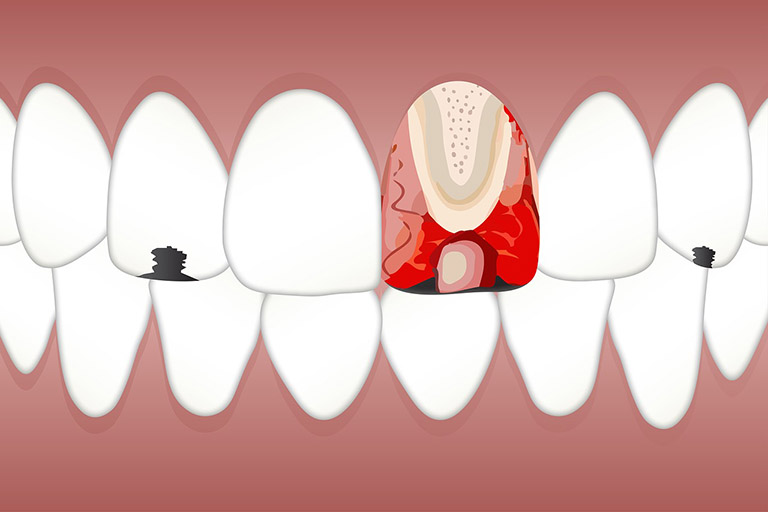 Viêm tủy răng có chữa được không