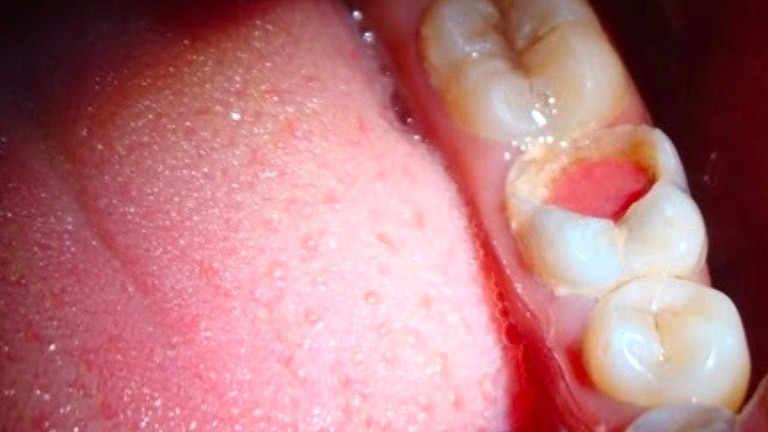 biến chứng viêm tủy răng
