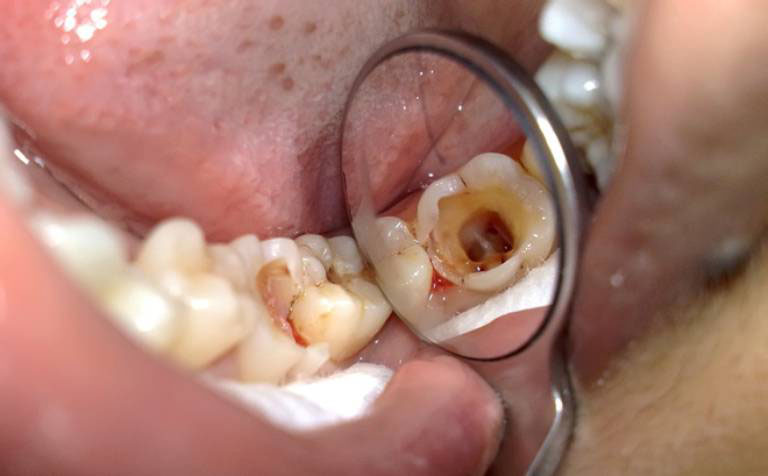 điều trị viêm tủy răng có hồi phục