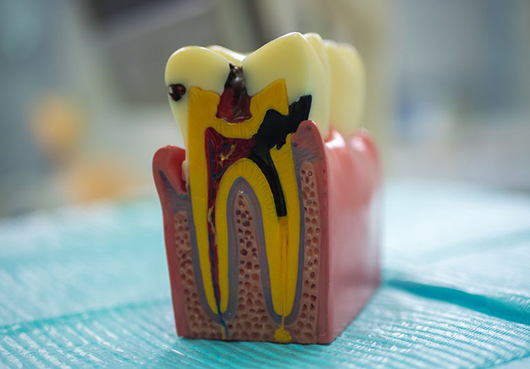 Viêm tủy răng hồi phục và không hồi phục