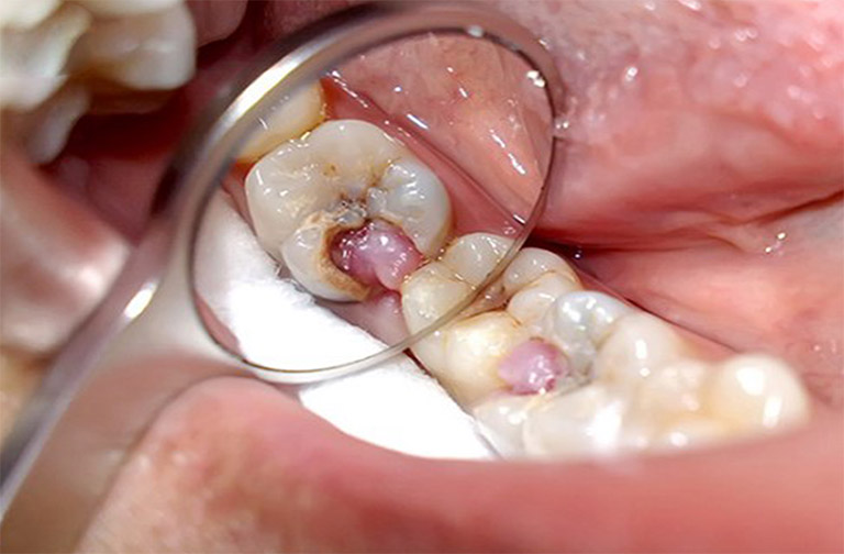 Viêm tủy răng mãn tính là gì