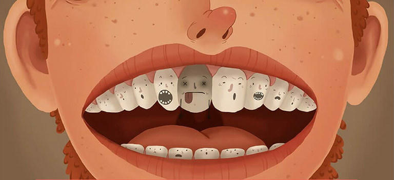 viêm tủy răng nặng