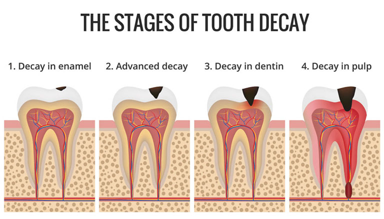 Các mức độ sâu răng
