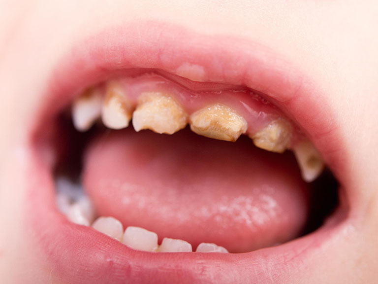 Cách điều trị sún răng cho trẻ