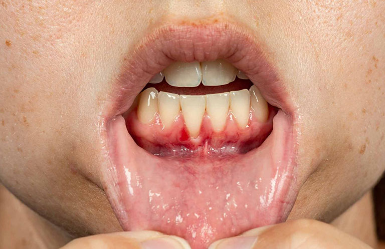 Đau răng dẫn đến sốt