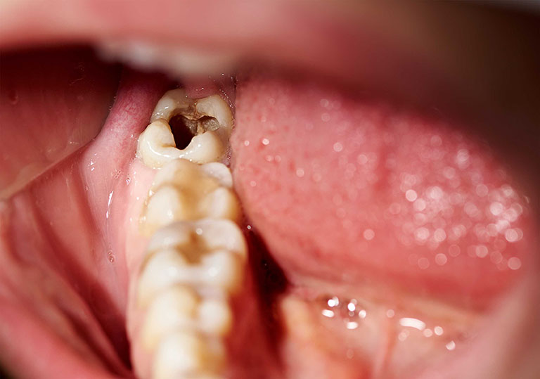 đau răng hàm khi nhai thức ăn