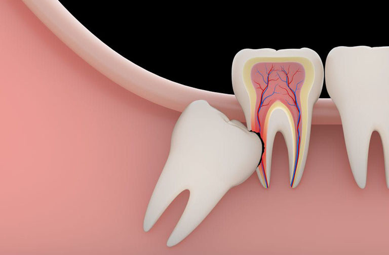 Đau nhức răng hàm trong cùng