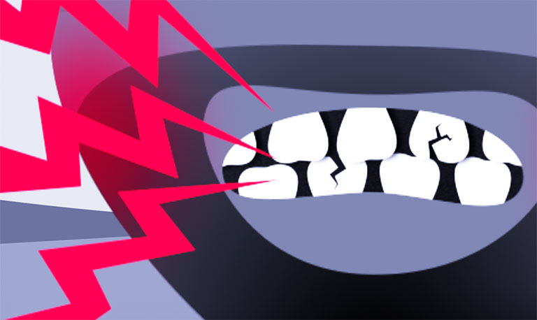 hiện tượng nhức răng vào ban đêm