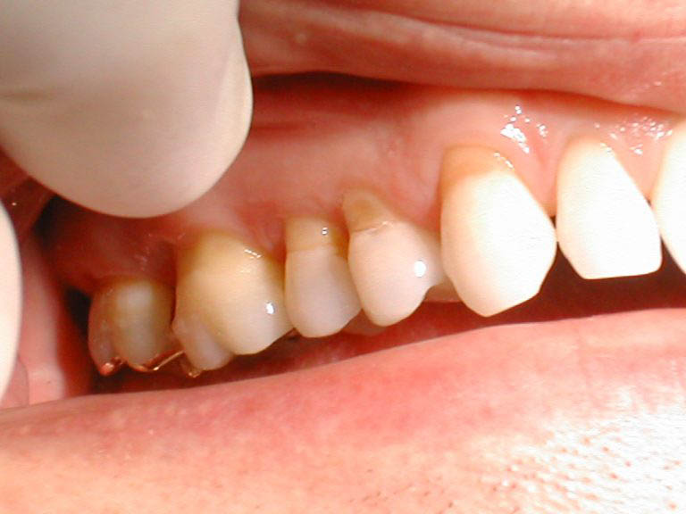 Phẫu thuật chữa tụt lợi chân răng
