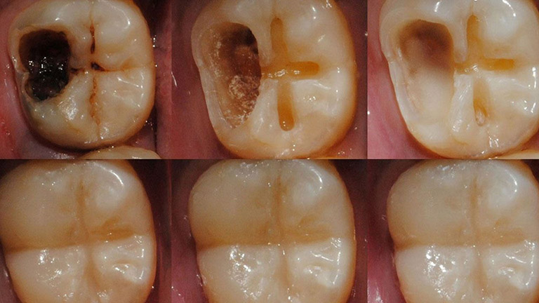 răng hàm bị sâu vào tủy