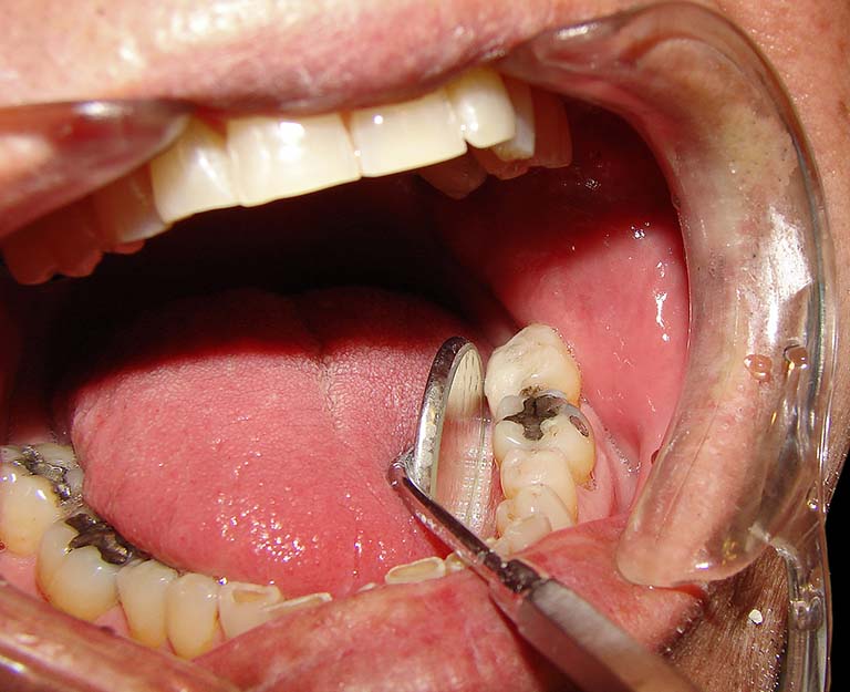 răng sâu bị lung lay có nên nhổ không