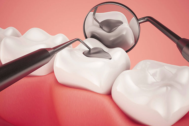 trám răng giúp chữa răng sâu nhẹ