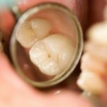 Sâu răng nhẹ có tự khỏi được không?