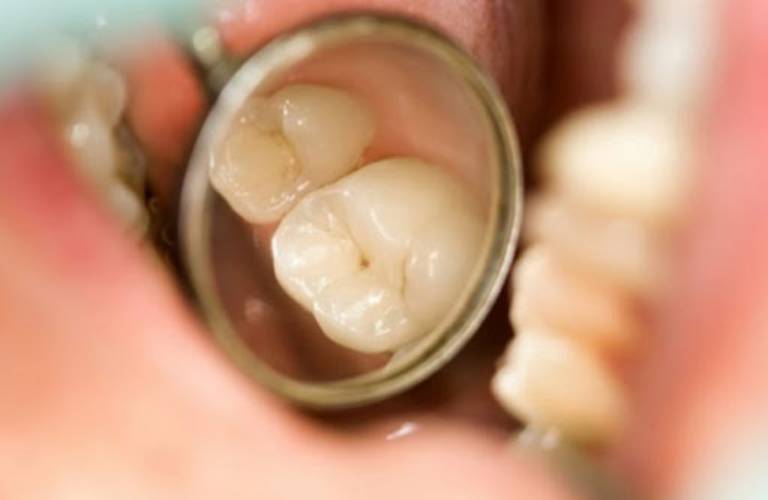 Sâu răng nhẹ có tự khỏi được không?